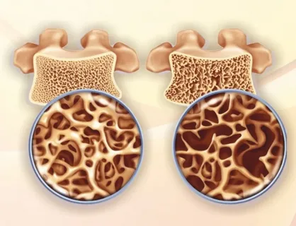 O  endocrinologista é um profissional habilitado para tratar Osteoporose